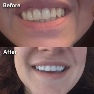 ByeYellow Purple Whitening Strips -7-Day Shocking Transformation Kit